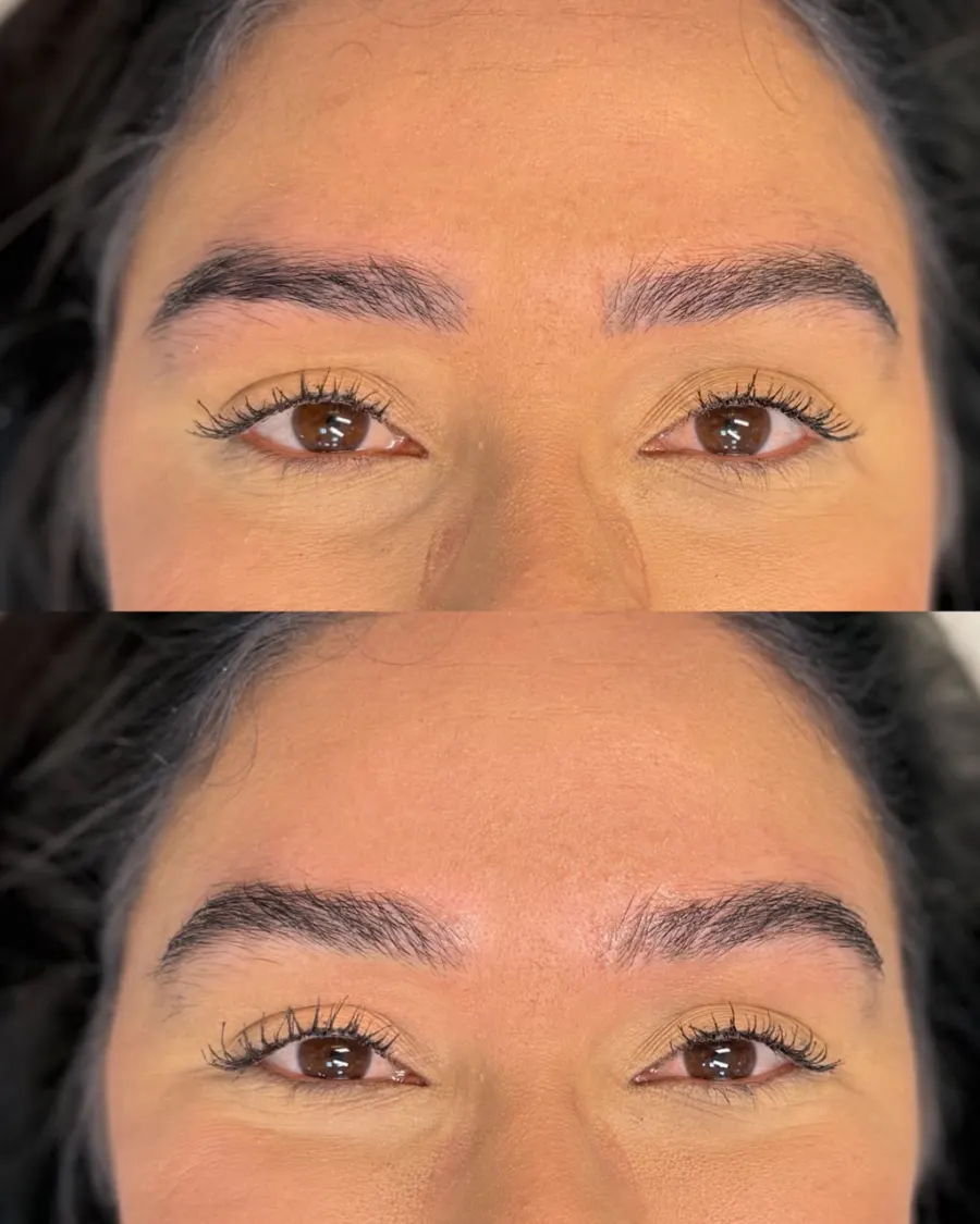 Resultado de remoção a laser, antes e depois — caso 1