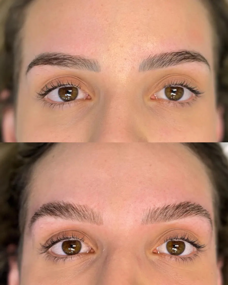 Resultado de remoção a laser, antes e depois — caso 2