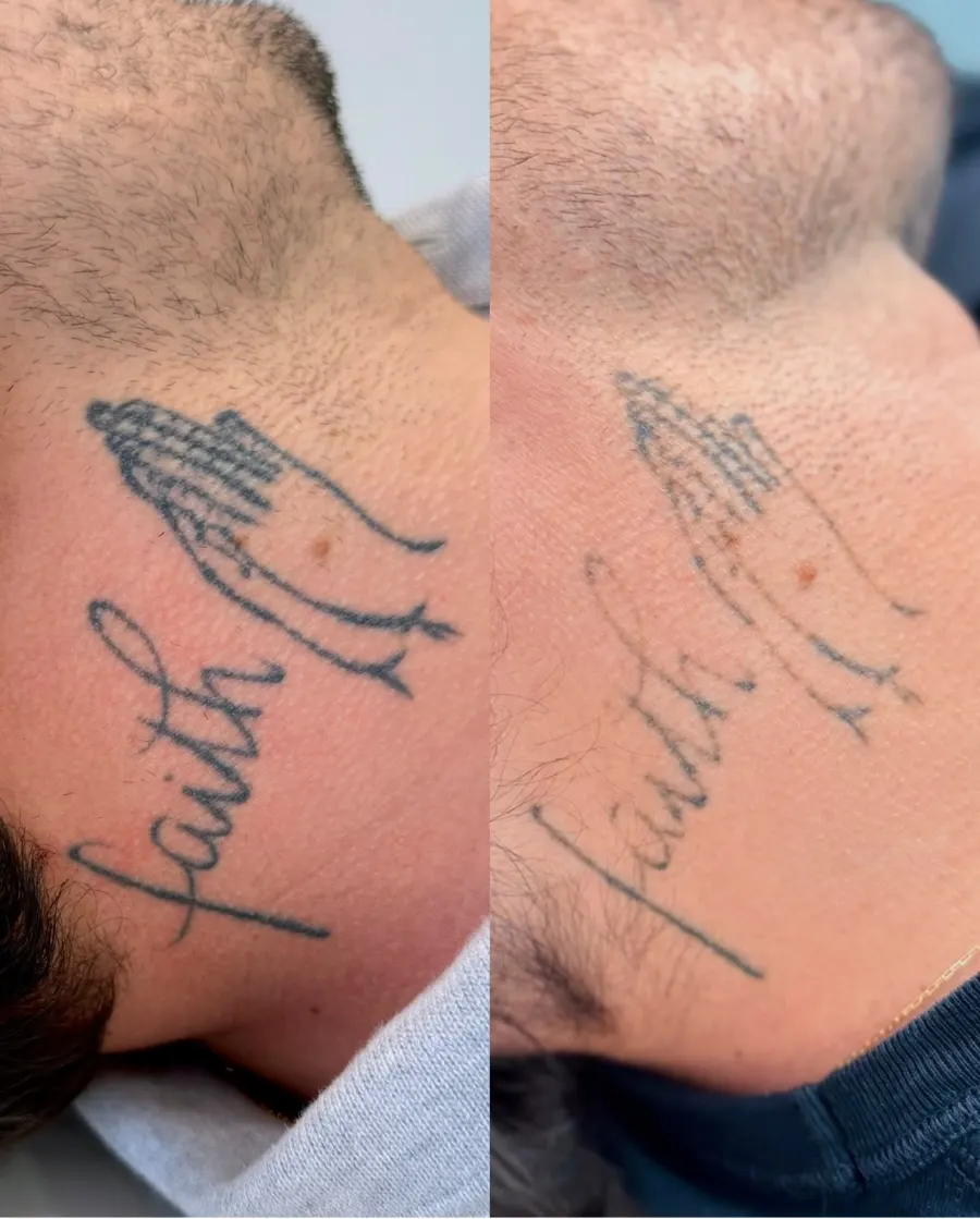 Resultado de remoção a laser, antes e depois — caso 3