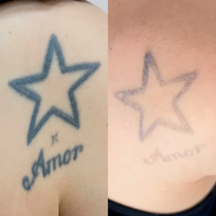 Resultado de remoção a laser, antes e depois — caso 4