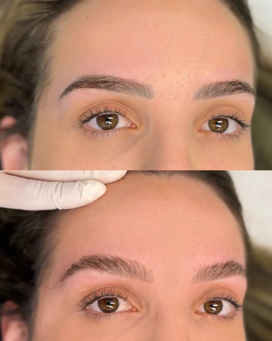 Resultado de remoção a laser, antes e depois — caso 5