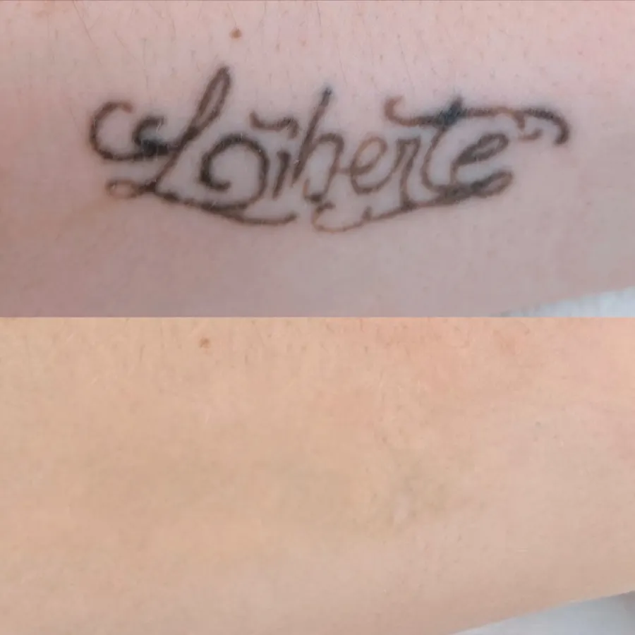 Resultado de remoção a laser, antes e depois — caso 6