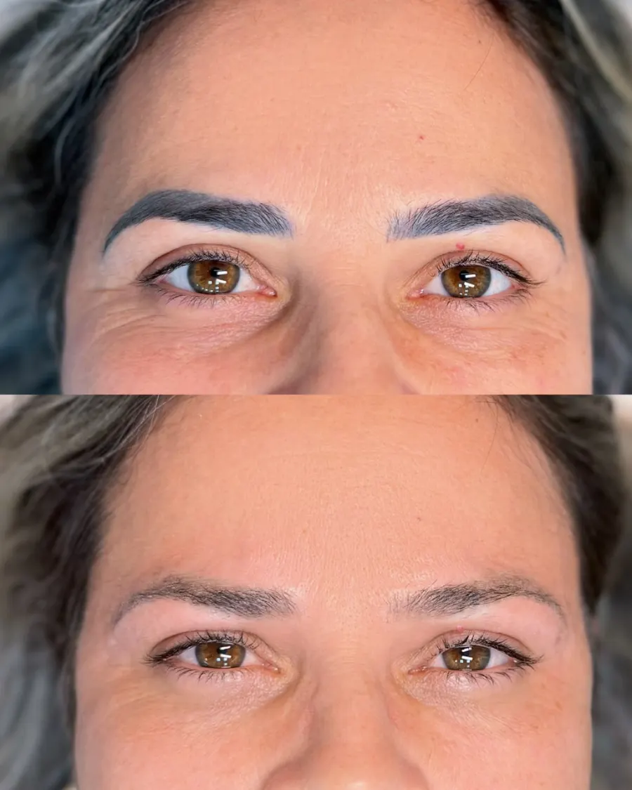 Resultado de remoção a laser, antes e depois — caso 7