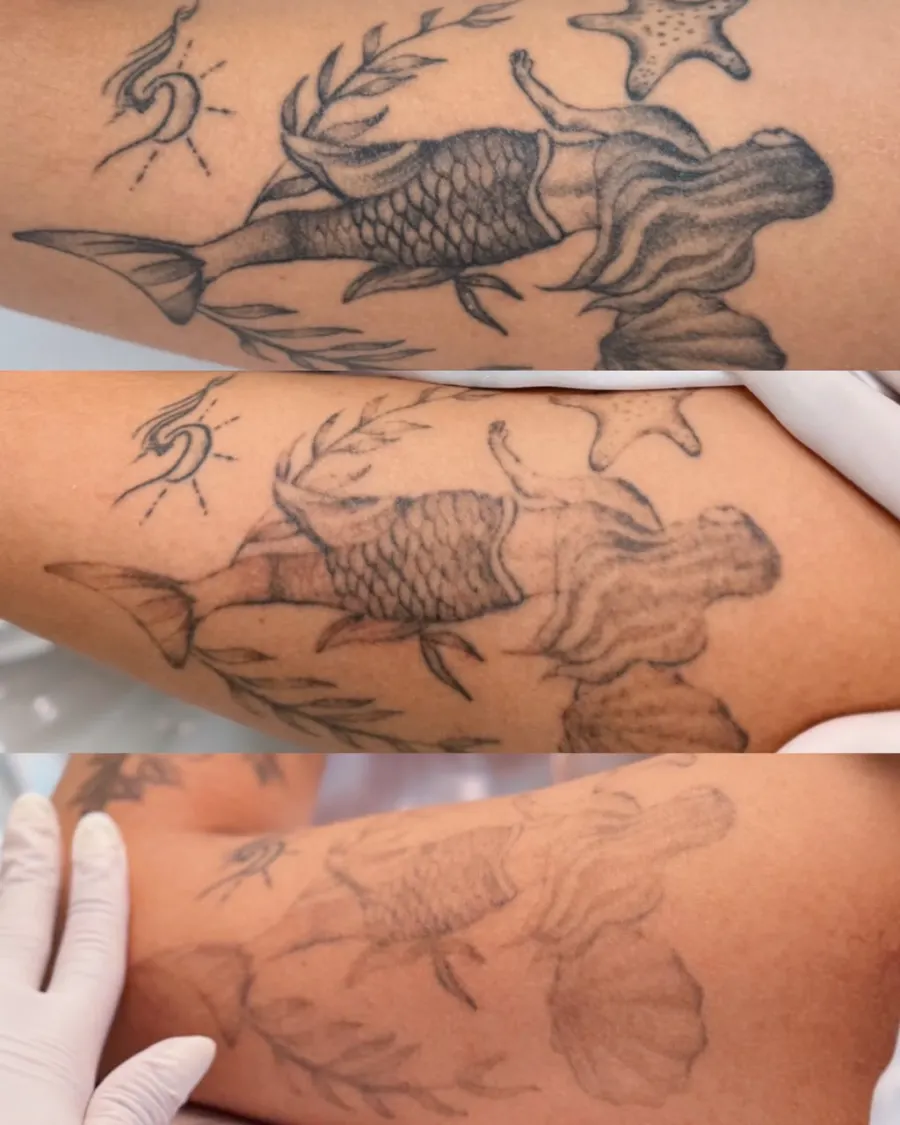 Resultado de remoção a laser, antes e depois — caso 8