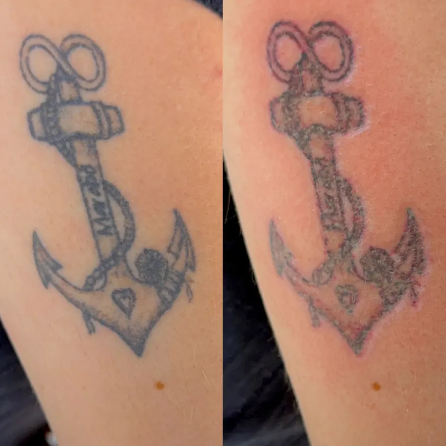 Resultado de remoção a laser, antes e depois — caso 9