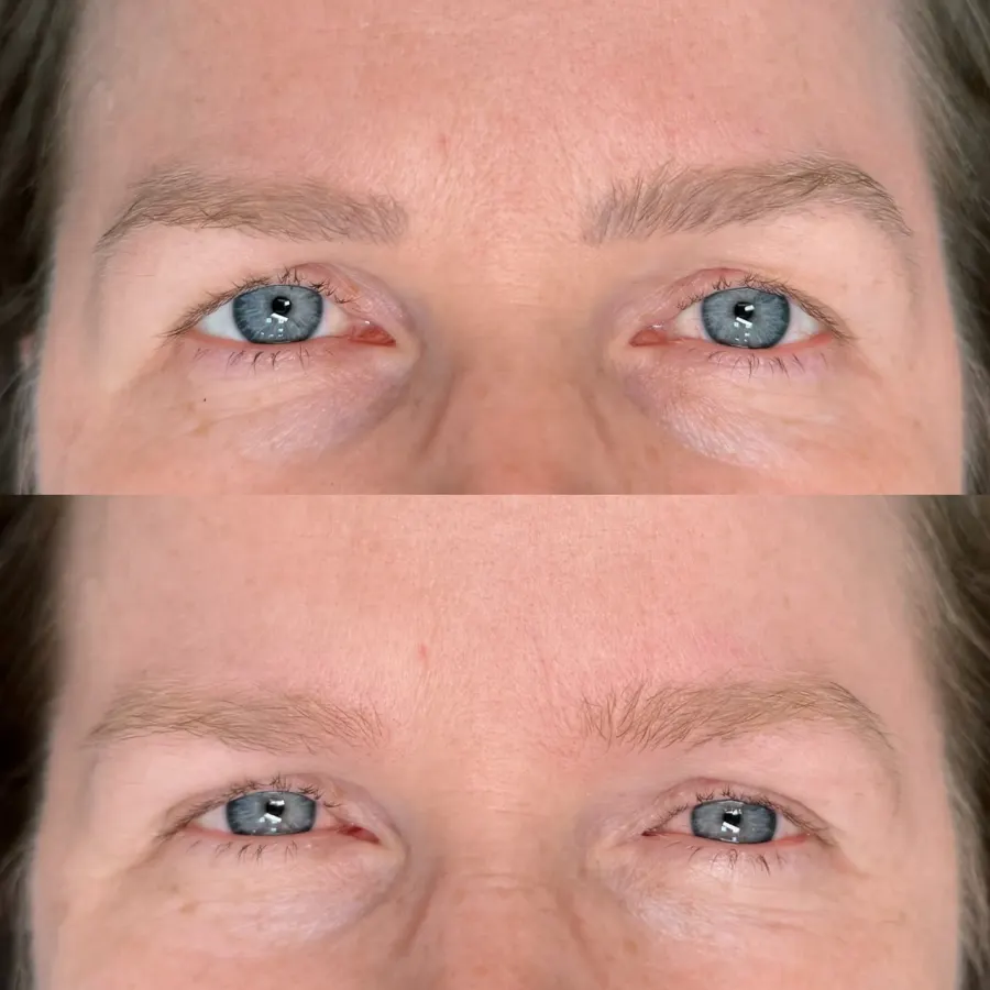 Resultado de remoção a laser, antes e depois — caso 10