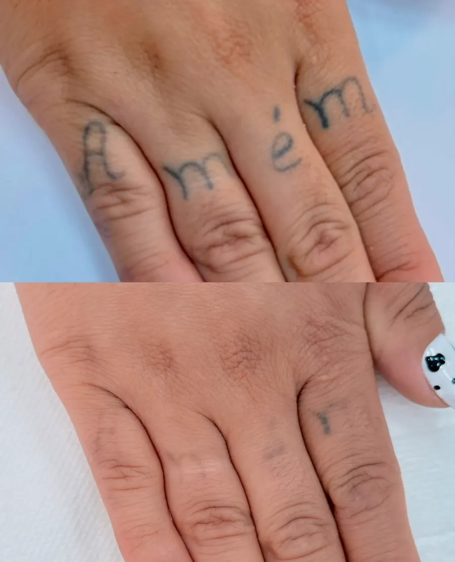 Resultado de remoção a laser, antes e depois — caso 11