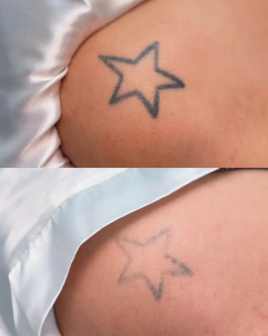 Resultado de remoção a laser, antes e depois — caso 12